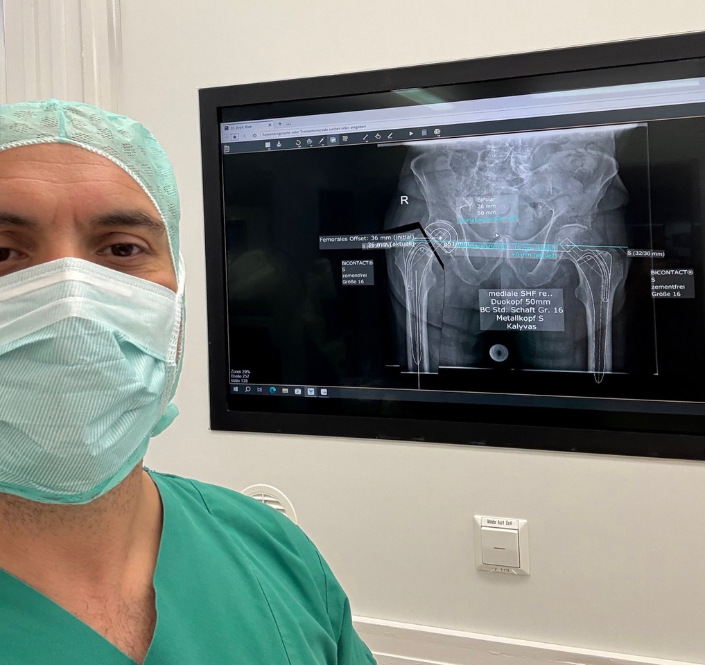 Imioliki arthroplastiki isxiou