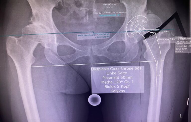 Oliki arthroplastiki me AMIS kai mikro stem