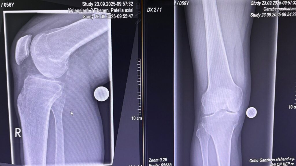 Ημιολικη αρθροπλαστικη Γονάτου Μονοκονδυλικη