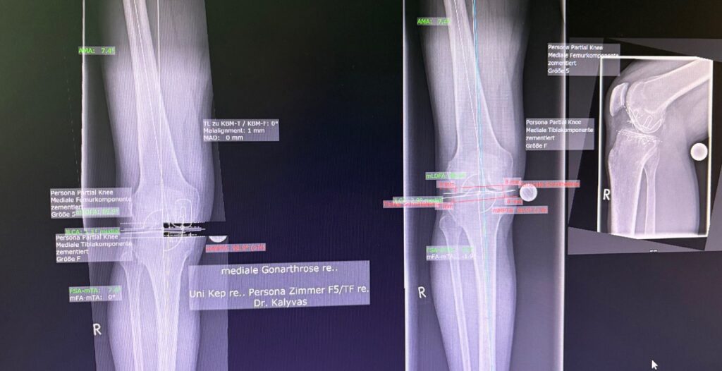 Ημιολικη αρθροπλαστικη Γονάτου Μονοκονδυλικη