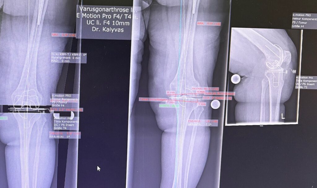 Ημιολικη αρθροπλαστικη Γονάτου Ρομποτική