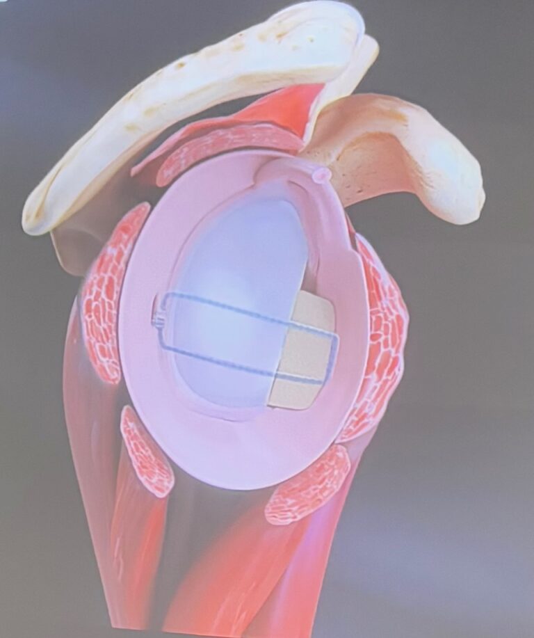 Arthroskopiseis Omou