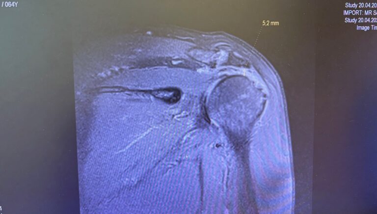 αρθροσκοπήσεις Ώμου